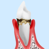 歯周病模式図